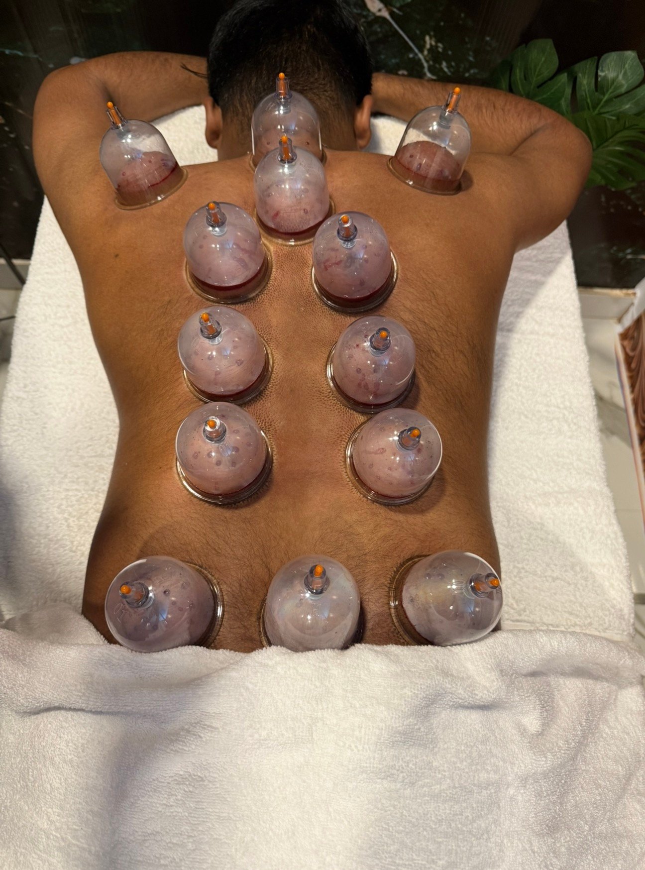 Clinical cupping therapy session